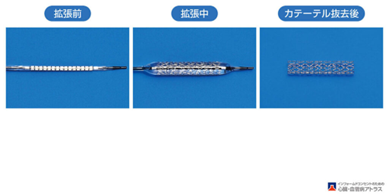 カテーテル治療(ステント留置)のイメージ