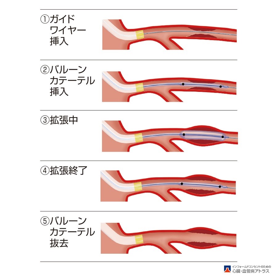 カテーテル治療(バルーン拡張)のイラスト