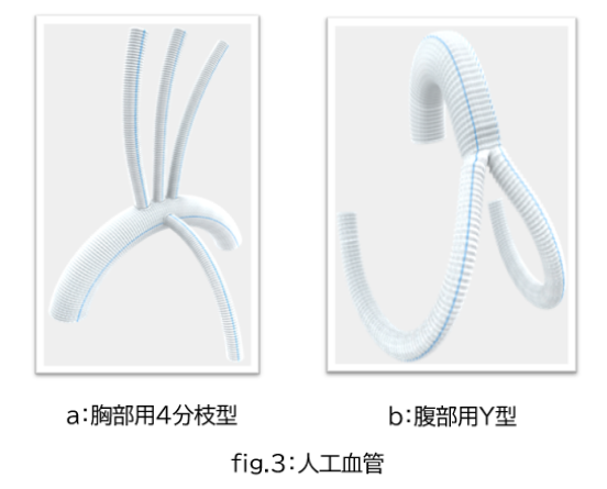 人工血管置換術